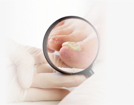 кератоз 1 (1).jpg