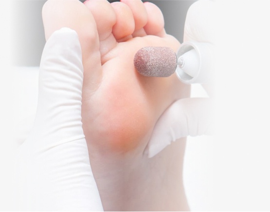 кератоз 1.jpg